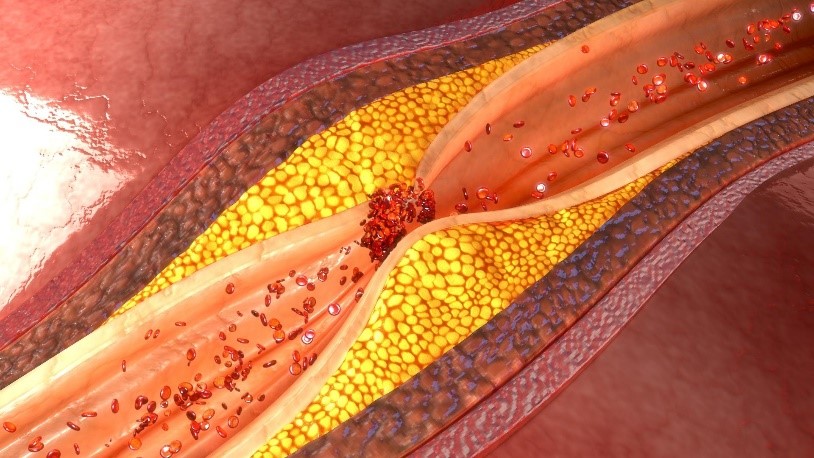 Fim das artérias entupidas: combinação de drogas previne aterosclerose - 14/10/2018 - UOL VivaBem
